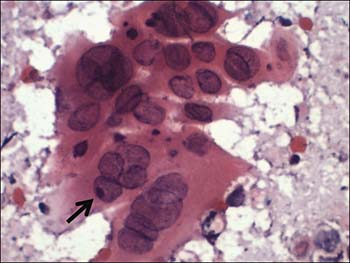 Tests & Diagnosis for Genital Herpes