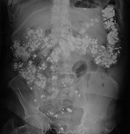 pica diagnosis and tests