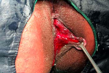 Similar conditions of Piles