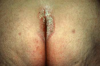 Symptoms of Psoriasis