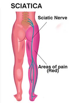 Sciatica Symptoms