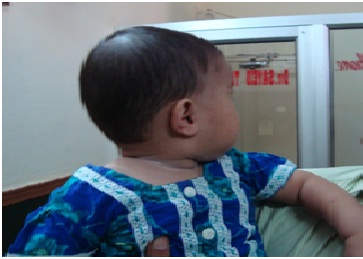 After_treatment_Abscess-case_img2